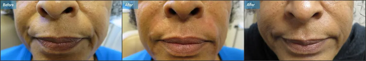 Before & After Image of Injectable Fillers Los Angeles CA