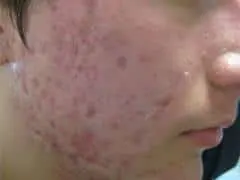 Front Acne Treatment Los Angeles CA