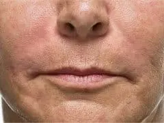 Before Image of Dermal Fillers Los Angeles CA