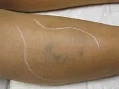 Spider & Varicose Veins Surgery Los Angeles CA