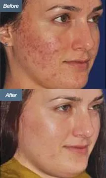 Before & After Micro-Needling Los Angeles CA