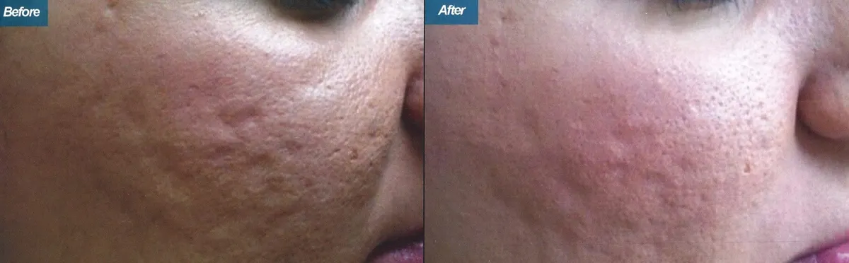 Micro-Needling Surgery Los Angeles CA
