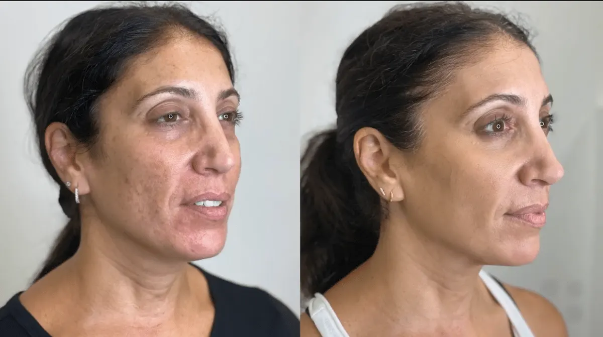 Before & After image of Hair Restoration Los Angeles CA