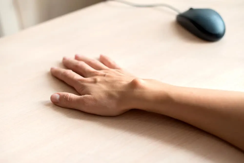 Epidermoid Cyst Treatment Los Angeles CA