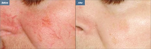 Before and After V Beam Los Angeles CA