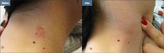 Before and After V Beam Treatment Los Angeles CA