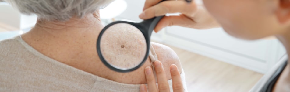 Skin Cancer Check Los Angeles CA