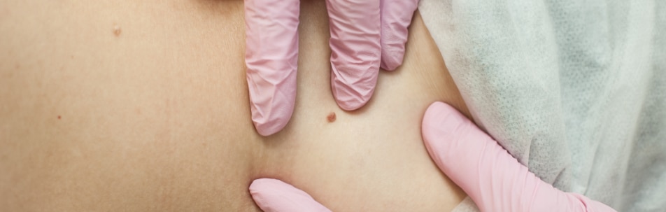Wart Removal Los Angeles CA