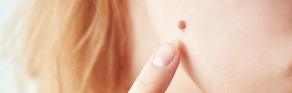 Mole Removal Los Angeles CA