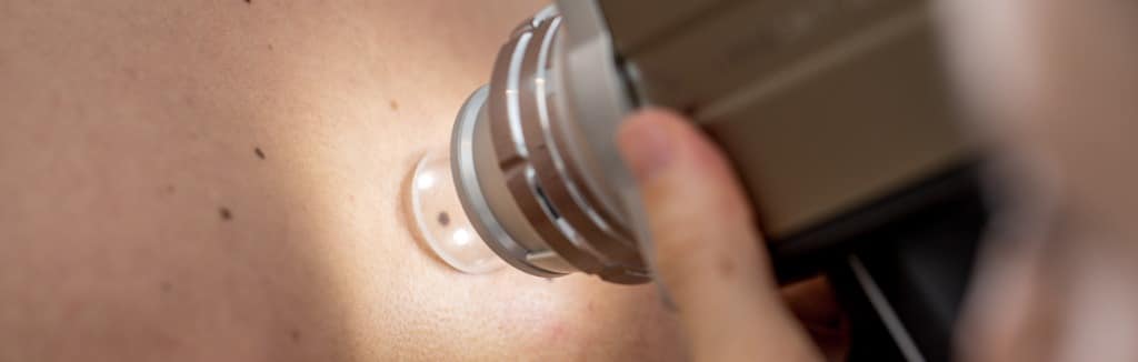 Photodynamic Therapy Los Angeles CA