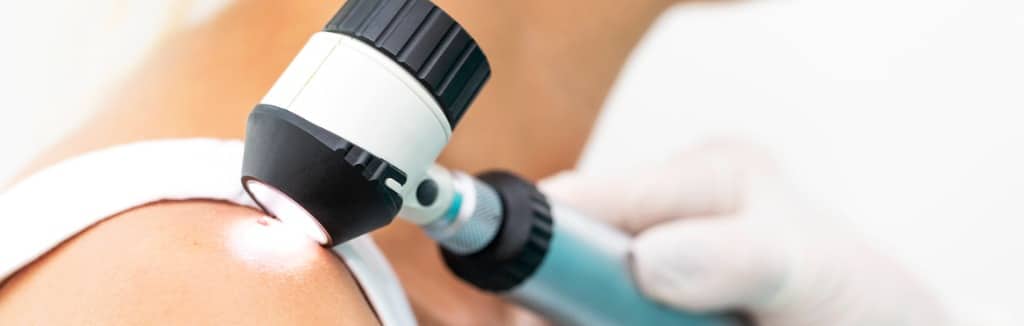 Melanoma Treatment Los Angeles CA