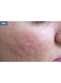 Microneedling after photo, close-up view (case 6468)