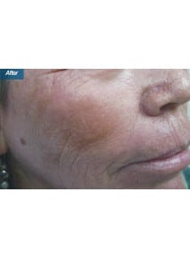 IPL after photo, oblique right view (case 9186)
