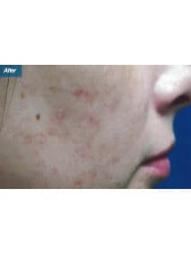 Microneedling after photo, right view (case 9204)