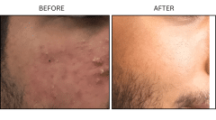 LB Medical Acne - Patient16