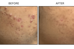 LB Medical Acne - Patient11
