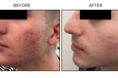 LB Medical Acne - Patient13a