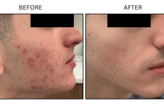 LB Medical Acne - Patient13b