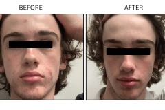 LB Medical Acne - Patient14