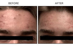 LB Medical Acne - Patient15