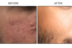 LB Medical Acne - Patient16