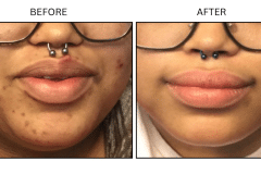 LB Medical Acne - Patient17