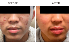 LB Medical Acne - Patient1a