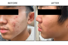 LB Medical Acne - Patient1b
