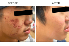 LB Medical Acne - Patient1c