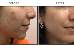 LB Medical Acne - Patient2a