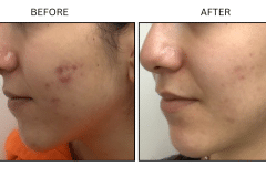 LB Medical Acne - Patient2b