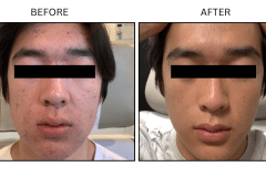 LB Medical Acne - Patient3