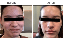 LB Medical Acne - Patient4a