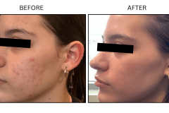 LB Medical Acne - Patient4b