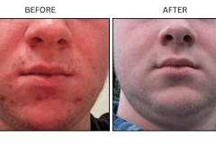LB Medical Acne - Patient5