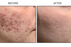 LB Medical Acne - Patient6a
