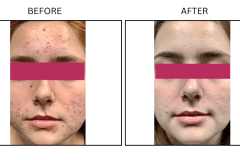 LB Medical Acne - Patient6b