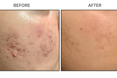LB Medical Acne - Patient7a