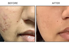 LB Medical Acne - Patient7b