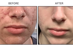 LB Medical Acne - Patient8