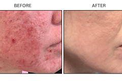 LB Medical Acne - Patient9