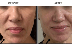 LB Fillers Cheeks - Patient2a