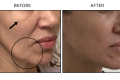 LB Fillers Cheeks - Patient2b