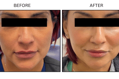 LB Fillers Cheeks - Patient4