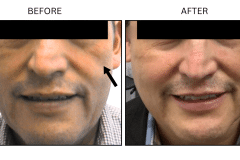 LB Fillers Cheeks - Patient5