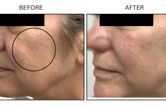 LB Fillers Cheeks - Patient6