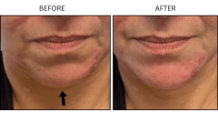 LB Fillers Chin - Patient1