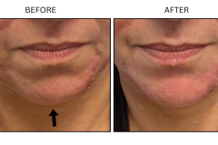 LB Fillers Chin - Patient1