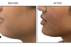 LB Fillers Chin - Patient2