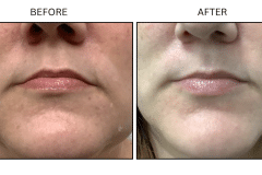 LB Neurotx Relx Corners of Mouth - Patient1